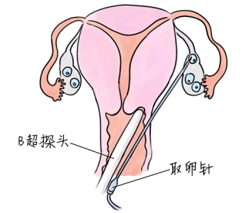 小儿退烧推拿手法 5种成都捐卵宝宝退烧按摩方法